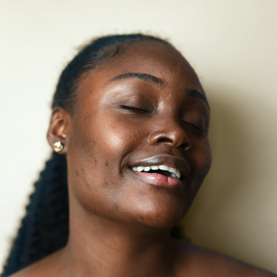 Hyperpigmentation - best skincare for dark marks