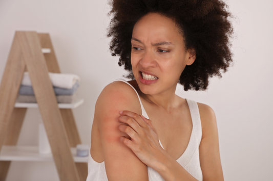 What is Eczema- How to Treat Eczema fast?