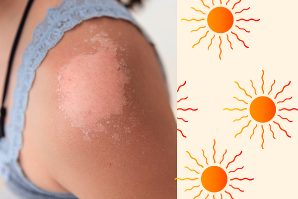 How To Soothe A Sunburn?