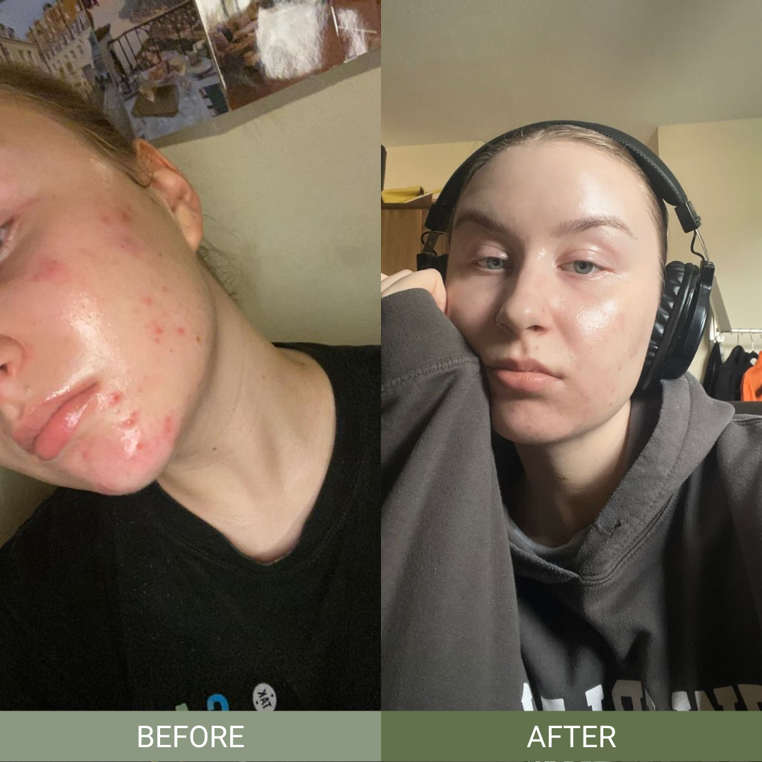 Brightening hyperpigmentation Serum